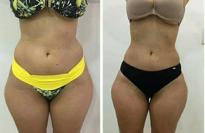 masajes reductores con maderoterapia